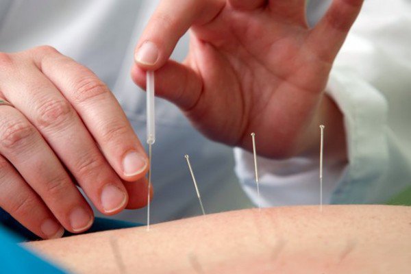  STF determina que somente médicos podem praticar acupuntura