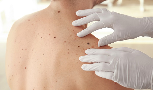  Estudo aponta aumento de incidência de câncer de pele no Brasil