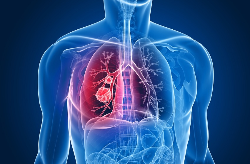  Diagnóstico tardio de câncer de pulmão eleva custo em R$ 80,4 milhões