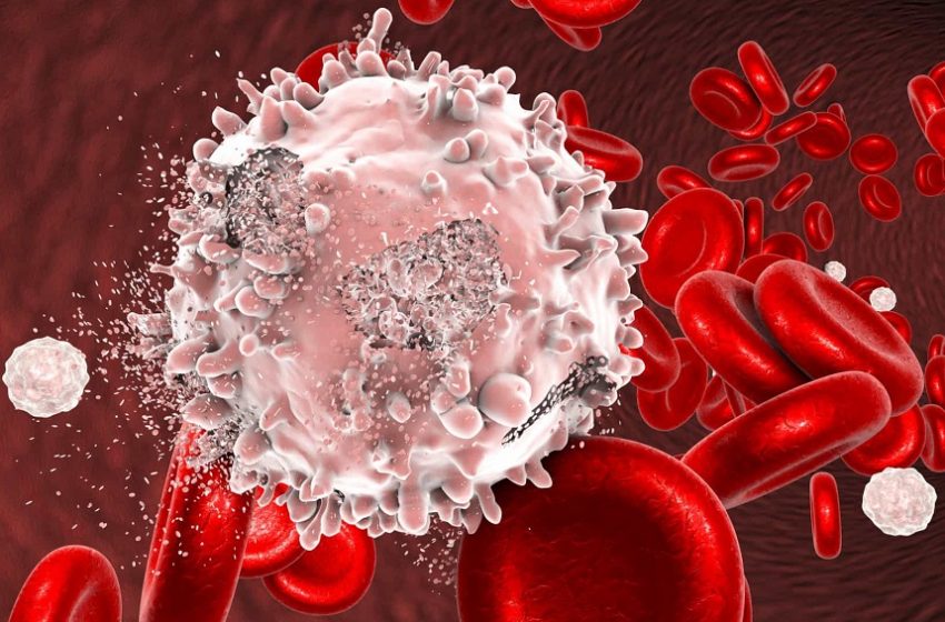  Pesquisa inédita revela o impacto da leucemia linfocítica crônica no Brasil