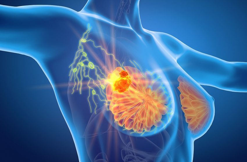  Congelar câncer de mama pode ser eficaz em mais de 90% dos casos