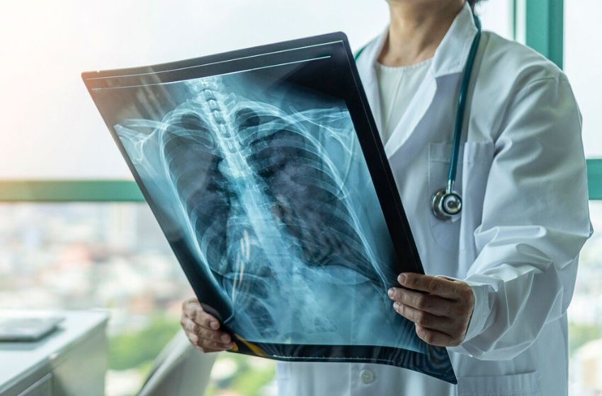  Quase 65% dos pacientes com fibrose pulmonar não fazem acompanhamento