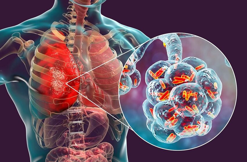  2025: Internações por pneumonia geraram custo de R$ 381 milhões