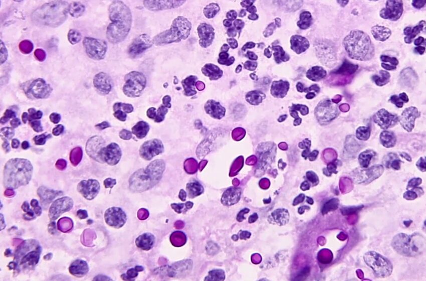  Cientista francês explica como fungos podem permanecer no corpo
