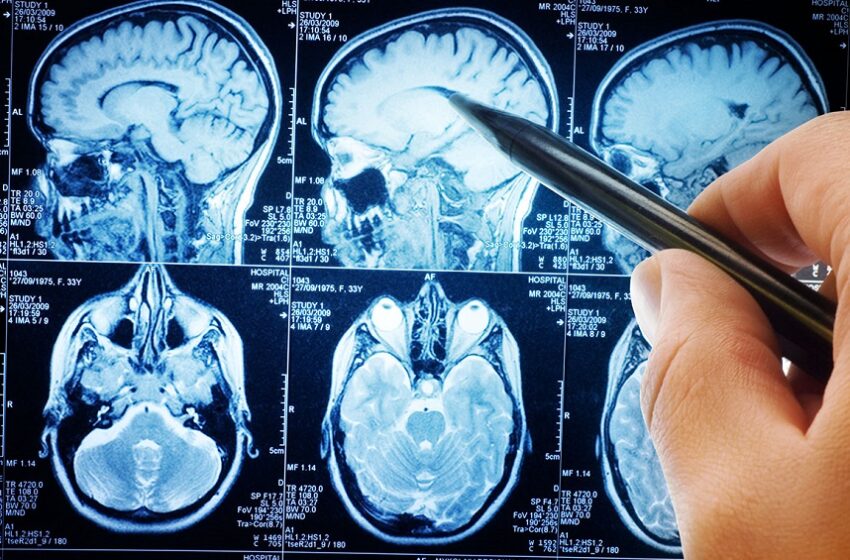  Registro de medicamento oral para tratar tumores cerebrais é aprovado
