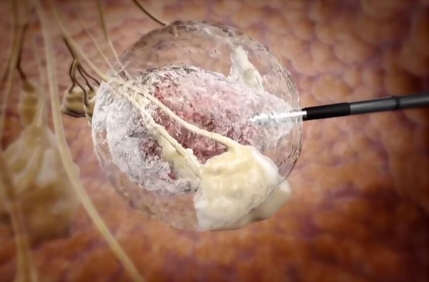  INRAD realiza estudos para tratamento de tumores por crioablação