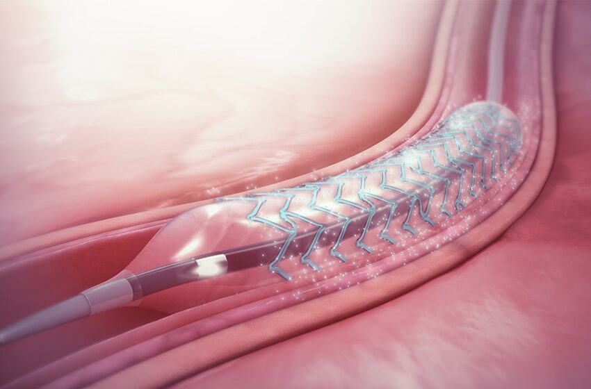  Maior estudo do mundo com stents em diabéticos reafirma eficácia do tratamento padrão atual